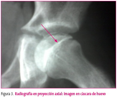 Figura 3. Radiografía en proyección axial: imagen en cáscara de huevo
