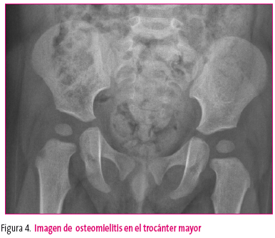 Figura 4. Imagen de osteomielitis en el trocánter mayor