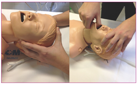 Figura 1. Técnicas de apertura de la vía aérea en el paciente politraumatizado. Elevación o subluxación mandibular (izquierda). Tracción mandibular (derecha)