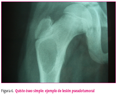 Figura 6. Quiste óseo simple: ejemplo de lesión pseudotumoral