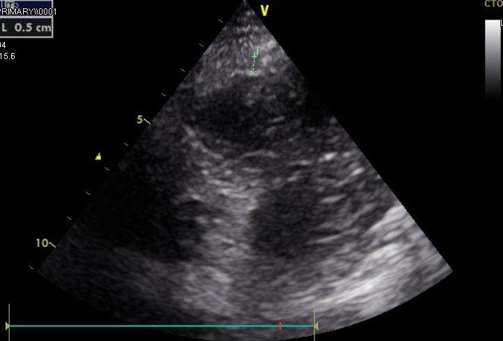 Figura 3. Ecocardiograma realizado a su llegada a Urgencias: se aprecia una imagen hiperrrefringente con una pequeña lengua de derrame.