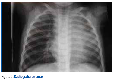 Figura 2. Radiografía de tórax