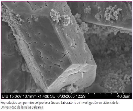 Figura 1. Detalle de un cristal de estruvita (fosfato amónico magnésico en cuyas caras se observan las marcas en “Y” que permiten su rápida identificación, junto con pequeñas zonas de esferulitos de hidroxiapatita