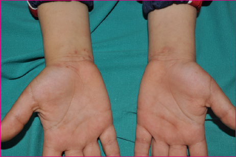 Figura 1. Lesiones típicas de sarna. Se aprecian lesiones papulosas
y pápulo-costrosas en la cara anterior de ambas muñecas