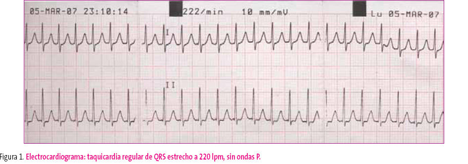 Figura 1. Electrocardiograma: taquicardia regular de QRS estrecho a 220 lpm, sin ondas P.
