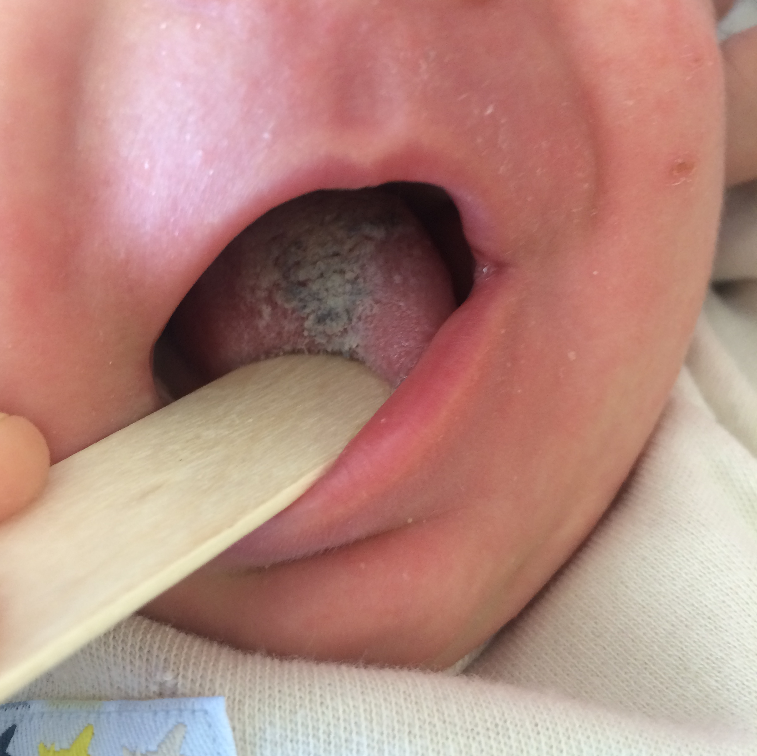 Figura 1. Lengua vellosa negra en un lactante.