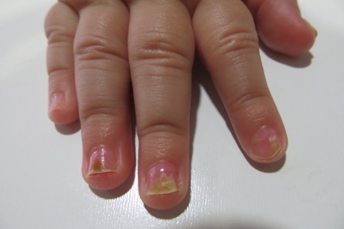 Figura 2. Coloración marronácea de las uñas de la mano derecha.