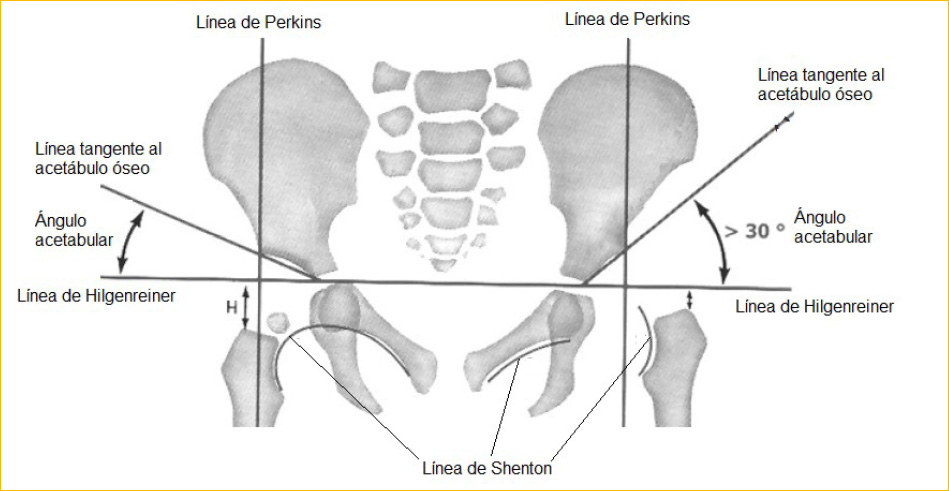 Figura 1. Representación esquemática de una radiografía de caderas (cadera derecha normal, cadera izquierda displásica)