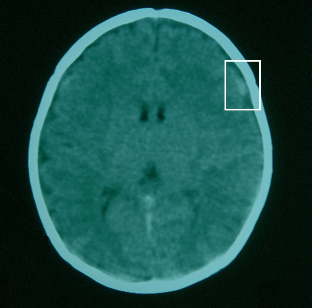 Lactante de mes y medio con cuadro de encefalopatía aguda y crisis convulsivas. La TC craneal muestra una imagen hiperdensa frontotemporal derecha compatible con hematoma subdural.