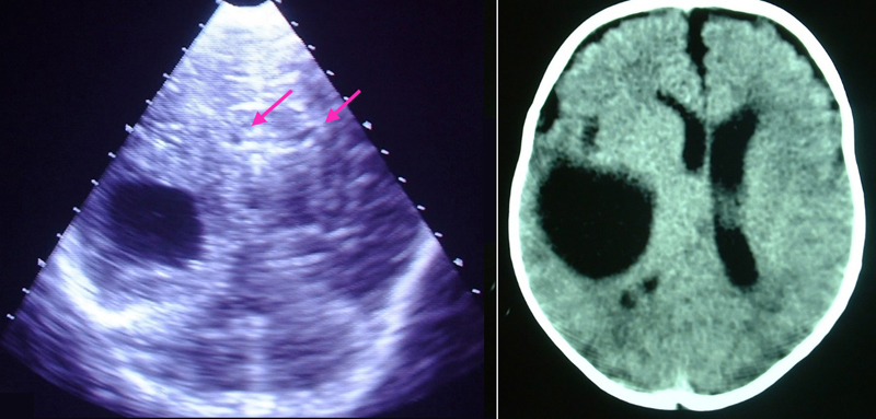 Quiste insuflante. La ecografía (izquierda), con el corte coronal, y la TC (derecha) muestran el quiste y la comprensión de los ventrículos laterales (flechas).