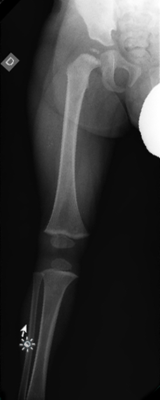 Radiografía inicial. Fémur y pierna derecha. Núcleo cefálico femoral con aspecto ligeramente fragmentado y deforme