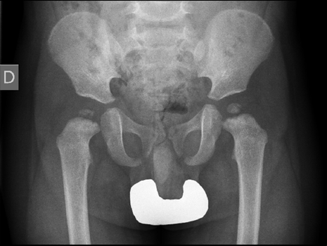 Radiografía anteroposterior de pelvis: fragmentación y disminución de altura del núcleo cefálico del fémur derecho