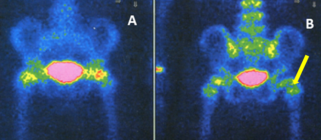 Gammagrafía posteroanterior. Las imágenes precoces (A) no muestran diferencia en la vascularización entre ambas caderas. En las imágenes tardías (B) se observa un área hipocaptante en cabeza femoral derecha