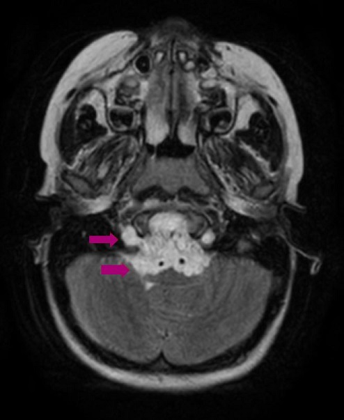 Tumor en la base del cráneo compatible con un cordoma de clivus.