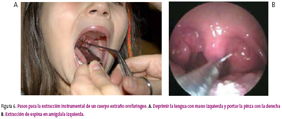 Figura 6. Pasos para la extracción instrumental de un cuerpo extraño orofaríngeo. A. Deprimir la lengua con mano izquierda y portar la pinza con la derecha
B. Extracción de espina en amígdala izquierda.