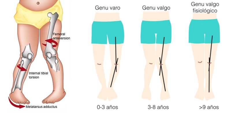 Deformidades torsionales y angulares de extremidades inferiores.