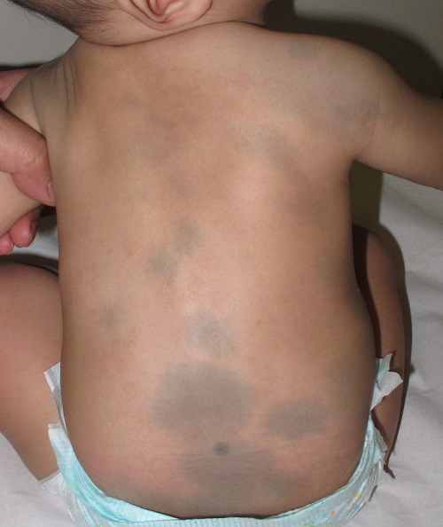 Mancha mongólica ectópica o aberrante.