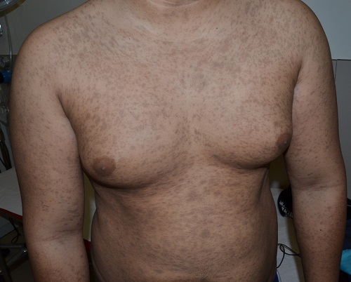 Hiperpigmentación posinflamatoria tras liquen plano.