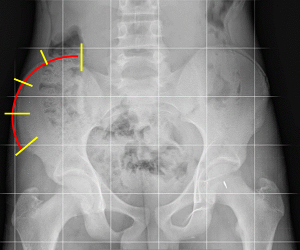 Esquema del test de Risser.