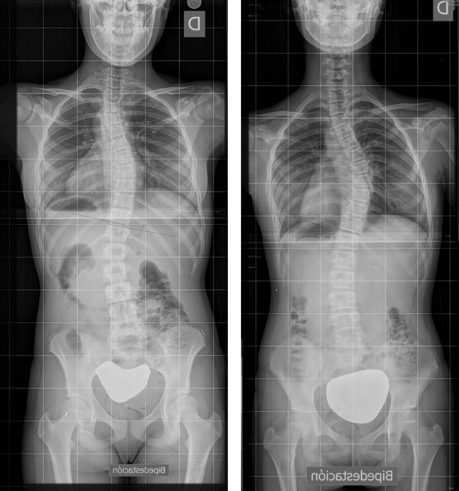 Deformidad de los arcos costales.