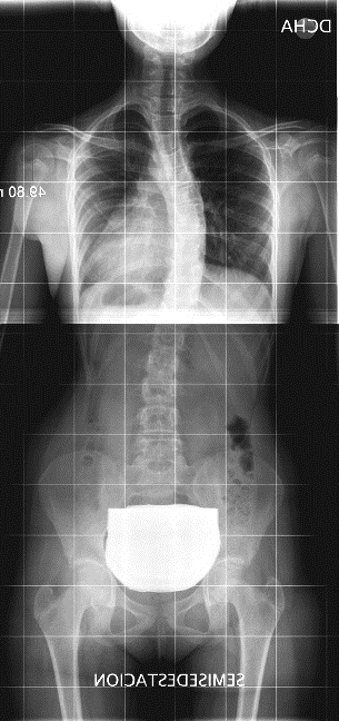 Simetría en los hombros pelvis y caderas con una grave escoliosis dorsal.
