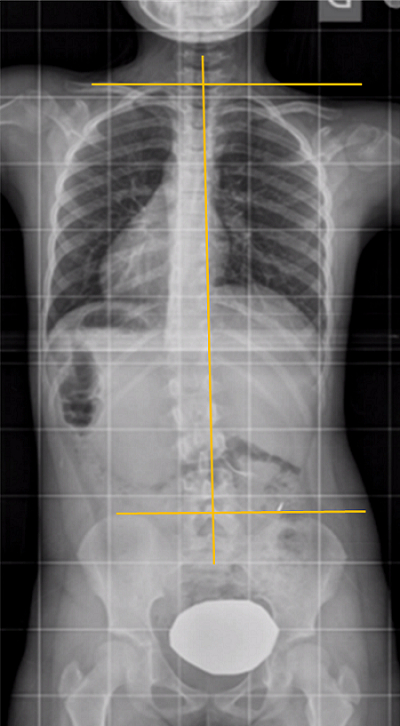 Escoliosis posicional. Inclinación del hombro hacia el lado más bajo. La columna vertebral se curva hacia el hombro que se ve más caído, indica que el paciente se inclinó armónicamente hacia ese lado.