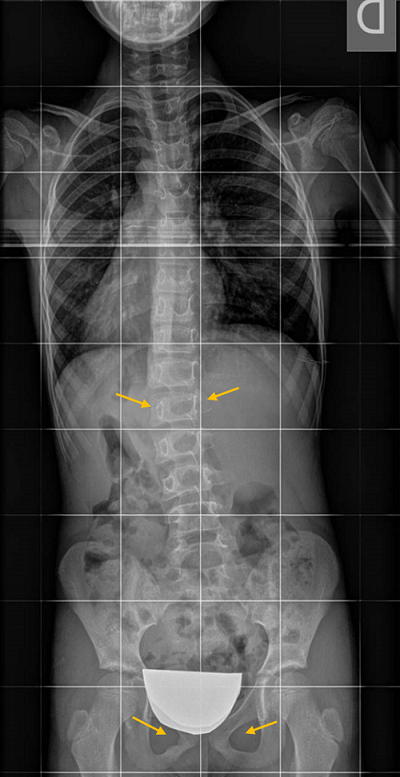 La L2 está muy rotada, como correspondería a una curva más grave, pero comprobamos que radiografía no está perfectamente simétrica, porque en la zona isquiopubiana los agujeros obturadores no se ven simétricos. Todo el tronco está rotado. A veces es difícil analizar estos agujeros porque se tapan con el plomo protector de los ovarios, o porque se colima tanto que se cortan la pelvis y los agujeros.