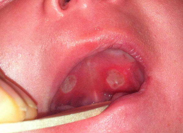 Úlceras de Bednar bilaterales