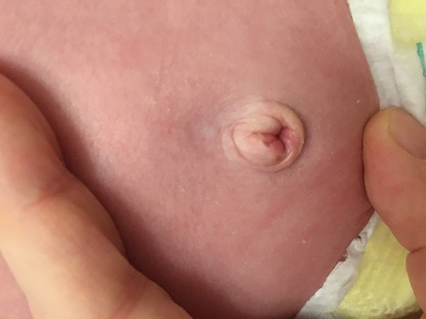 Resolución del granuloma a la semana