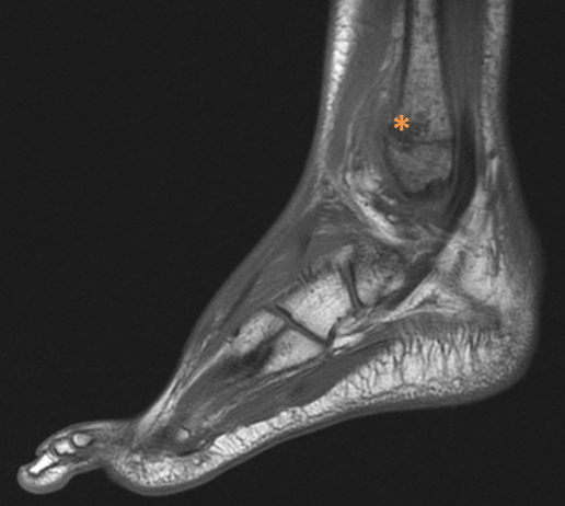 Lesión hipointensa en T1, de morfología ovoidea, con diámetros 21,6 × 16,5 × 12,5 mm, localizada en la parte distal del peroné, sugerente de osteomielitis.