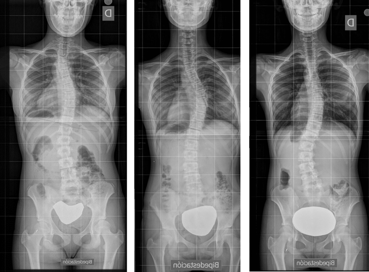 Telerradiografía de escoliosis de una paciente a lo largo del tiempo.