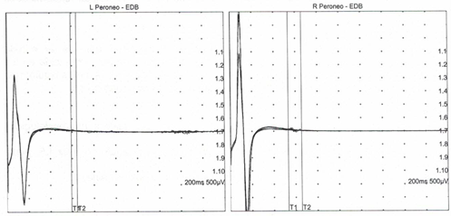 Figura 2. Representación de la latencia de la onda F en el nervio peroneo izquierdo y derecho, en nuestro paciente. 