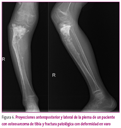 Figura 6. Proyecciones anteroposterior y lateral de la pierna de un paciente con osteosarcoma de tibia y fractura patológica con deformidad en varo