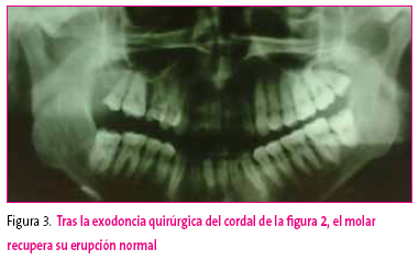 Figura 3. Tras la exodoncia quirúrgica del cordal de la figura 2, el molar recupera su erupción normal