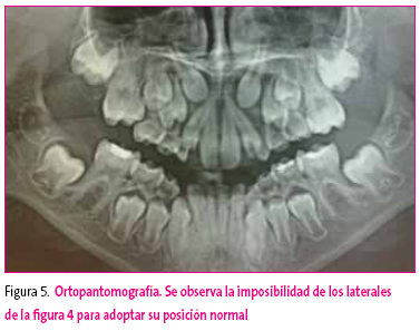 Figura 5. Ortopantomografía. Se observa la imposibilidad de los laterales de la figura 4 para adoptar su posición normal