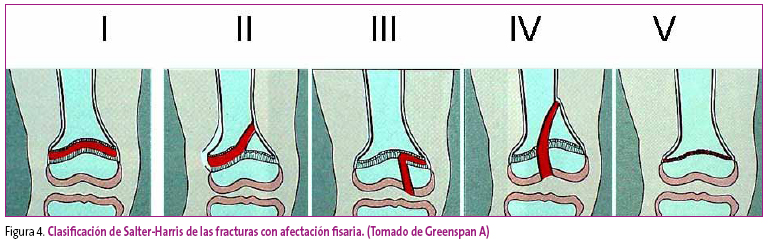 Figura 4. Clasificación de Salter-Harris de las fracturas con afectación fisaria. (Tomado de Greenspan A)