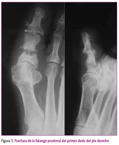 Figura 5. Fractura de la falange proximal del primer dedo del pie derecho