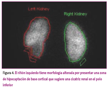 Figura 4. El riñón izquierdo tiene morfología alterada por presentar una zona de hipocaptación de base cortical que sugiere una cicatriz renal en el polo inferior