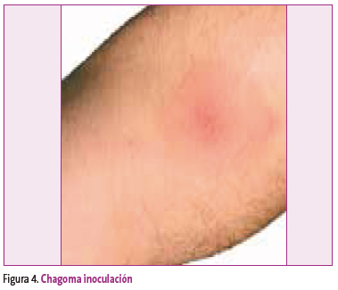 Figura 4. Chagoma inoculación