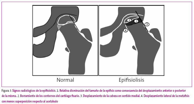 Figura 3. Signos radiológicos de la epifisiolisis