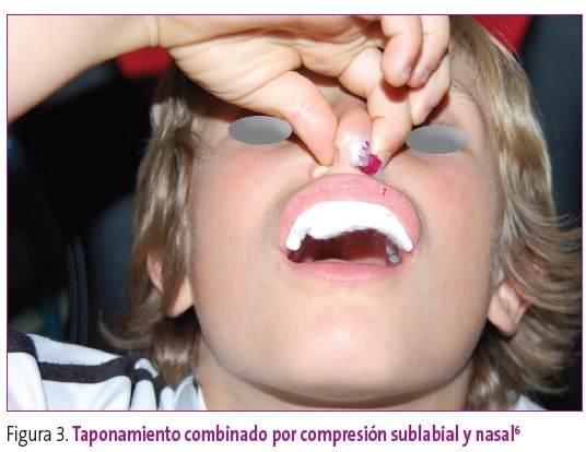 Figura 3. Taponamiento combinado por compresión sublabial y nasal